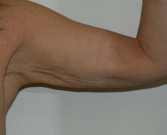 Feel Beautiful - Arm reduction San Diego Case 3 - Before Photo